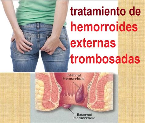 hemorroides trombosadas - como son las hemorroides